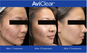 Laser acne solution for teenagers aged 13 and up
